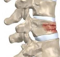 Image result for Vertebral Compression Fracture