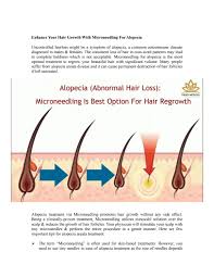 How often should you microneedle for hair growth? Microneedling For Alopecia By Bettyandrews Issuu
