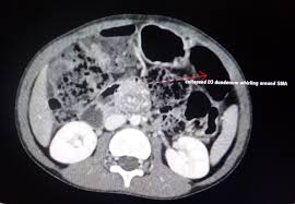 Image result for Midgut Volvulus