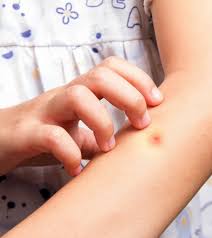 Check spelling or type a new query. 7 Remedies To Treat And Prevent Mosquito Bites On Kids