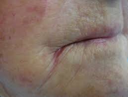 Iron deficiency symptoms can include the swelling of your tongue. Iron Deficiency Dermnet Nz