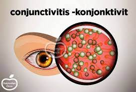 Conjunctivitis Neden Olur Conjunctivitis