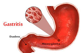 This is especially true if you use their juice. Home Remedies For Gastritis Natural Treatment