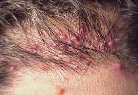 Rub your face in a circular motion every day using a wet washcloth or an exfoliating scrub to tease out ingrown hairs. Ingrown Hair On Scalp Head Causes Symptoms Cyst Bump Back Shampoo Pictures Removal Remedies