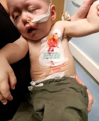 Eli had some issues with his port today. It got stuck so they changed the  needle and still it wouldn't flush, so they put in some stuff called TPA,  which has worked