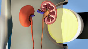 Removal Of Kidney Stones Swl Youtube