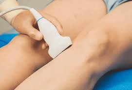 The quantity of foam injected into the hemorrhoids was 1 to 2 cc with a total of 6 cc for each session. Ultrasound Guided Foam Sclerotherapy Saint Joseph Mo Nellestein Vein Institute