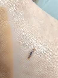 Linear mark bottom sole middle : r/Melanoma