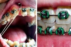 Elastics come in different lengths and are used to apply additional forces to the teeth to achieve. How Long Do You Have To Wear Rubber Bands For Braces Orthodontic Braces Care