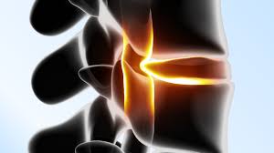 Image result for vyhřezlá ploténka