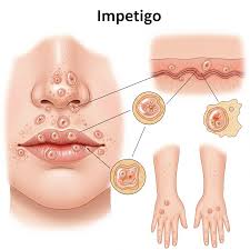 Image result for Impetigo