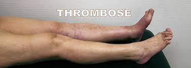 Bei der arteriellen thrombose stehen ursächlich gefäßveränderungen (arteriosklerose) und komplikationen einer thrombose bestehen in der ablösung und fortschwemmung des thrombus. Thrombose Phlebothrombose Phlebologie Angiologie Lymphologie