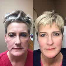 Botox at Be You Medical Spa : Prestonsburg KY : 606-207-8364