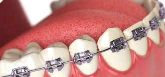 Check spelling or type a new query. Kenali Dulu Macam Macam Jenis Behel Sebelum Memakainya Fdc Dental Clinic