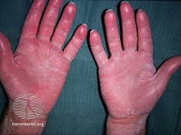 Image result for Ichthyosis