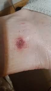 Image result for wolf spider bite skin
