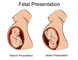 Breached baby pregnancy by pappy2000: Delivering Breech Babies By C Section Birth Injury Lawyers