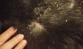 Image result for what do Cheyletiella look like in dog fur