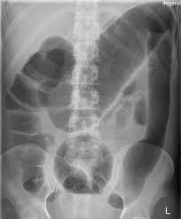 Image result for Abdominal XRay