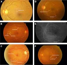 Change the page's background color to the reseda or night mode and you can click a block to make it changing color. Guidelines On Diabetic Eye Care Ophthalmology