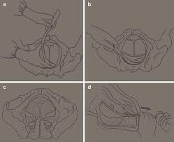 Image result for Manual Rotation in Occipitoposterior Presentation