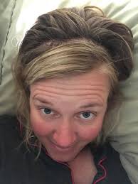 Recovery timeline after craniotomy surgery for AVM in brain?