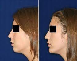 Many Patients With Receding Chins Lines Opt To Have Chin Augmentation When Undergoing A Rhinoplasty A Chin Implant Chin Augmentation Rhinoplasty Chin Implant