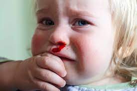 Broken Nose How Can I Tell Hospitality Health Er