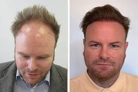Hair Transplant Cost in uk