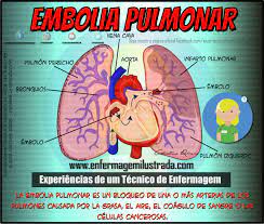 .pulmonar o tromboembolismo pulmonar, ocurre generalmente por un deslocamento de un coágulo o placa de ateroma que se genera en los miembros inferiores(trombosis) es un proceso por el que el tejido pulmonar se engrosa y se vuelve menos elástico, dificultando progresivamente la respiración. Que Es La Embolia Pulmonar Enfermeria Ilustrada