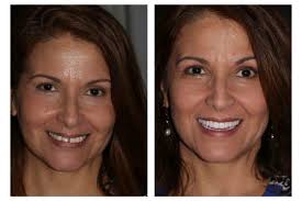 Before & After Photos