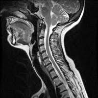 You may have a lump in white patches on your tongue or the lining of your mouth that do not go away. My Voice Imaging Mri Pet Ct Scans X Rays Ultrasound In Head And Neck Cancer