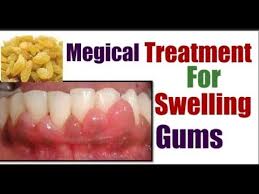 See full list on wikihow.com How To Get Rid Of Swollen Gums How To Get Rid Of Gum Swelling Home Remedies For Gum Infection Youtube