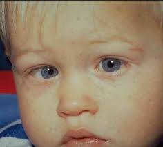 It may be quieter, husky, or sound as if you have a cold all the time. Signs And Symptoms Of Retinoblastoma We C Hope