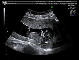 A dating scan is an ultrasound scan carried out at around 12 weeks of pregnancy, that's used to work out your due date. First Things First Images For A Proper Nuchal Translucency In The First Trimester 11 13 6 Weeks Scan Springerlink