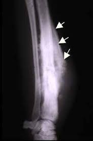 Image result for Osteosarcoma