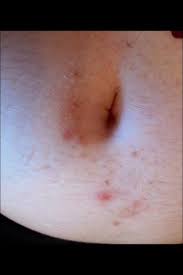 Only ingrown hair removals allowed! How To Get Rid Of Red And Brown Ingrown Hair Scars Underneath Belly Button Due To Shaving And Picking Photos
