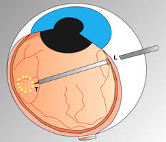 Retina Cerrahisi Vitrektomi Ameliyati Neoretina