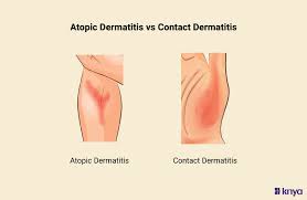 Image result for contact dermatitis