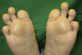 Congenital Lesser Toe Abnormalities
