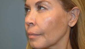 Melasma and Post Inflammatory Hyperpigmentation Treatment Update