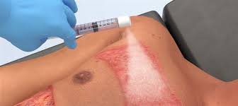 Fda Approves First Spray On Skin Treatment For Burns