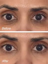 Amazon.com : BOLOBRE Under Eye Patches