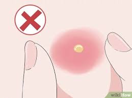 This will decrease the pain and help draw the when the boil starts draining, wash it with an antibacterial soap until all the pus is gone and clean with rubbing alcohol. How To Cure Boils Can Natural Remedies Help