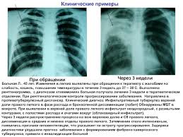 Infiltrativnyj Tuberkulez Legkih Prezentaciya Doklad