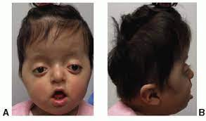 Craniosynostosis Syndromes | Plastic Surgery Key