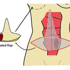 Northshore plastic surgery llc, mandeville. Pdf The History Of The Fleur De Lis Technique A Review Of The Literature And Case Report