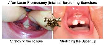 After Laser Frenectomy Infants Frisco Kid S Dentistry