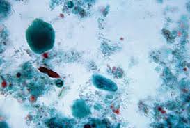 Image result for Stool Leukocytes