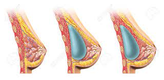 The shoulder muscles bridge the transitions from the torso into the head/neck area and into the upper extremities of the arms and hands. Woman Breast Implant Cross Section Comparison Diagram Under Stock Photo Picture And Royalty Free Image Image 27545560